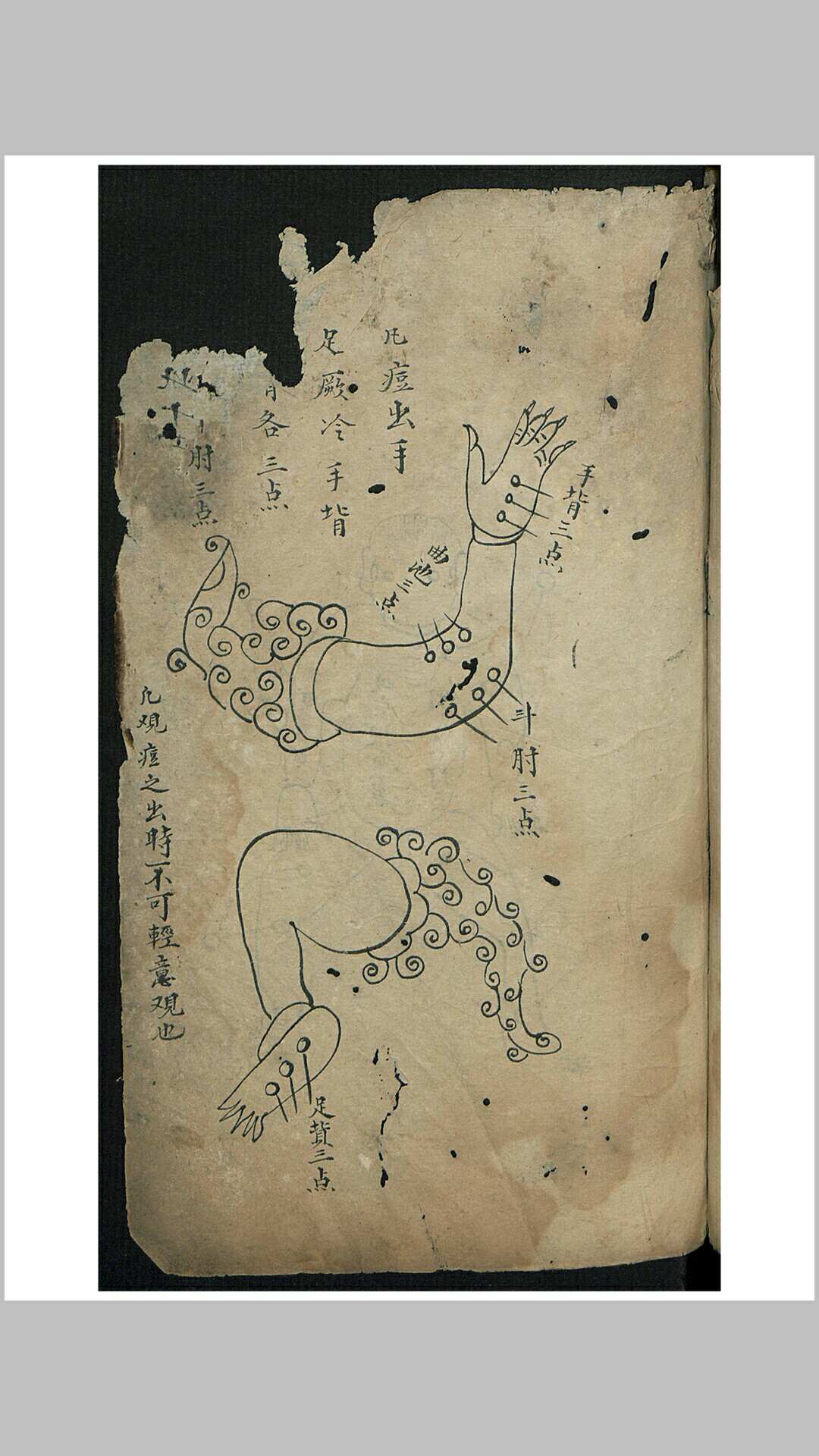 痘疹点烙及诊治